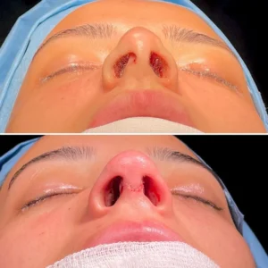 Септопластика в Турции Celal Alioglu
