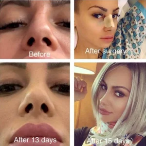 Септопластика в Турции Engin Ocal