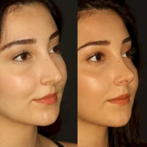 Септоринопластика в Турции Engin Ocal