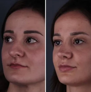 Септоринопластика в Стамбуле Yavuz Selim Yildirim