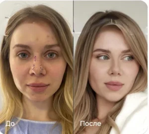 Ринопластика в Стамбуле Safak Aktar