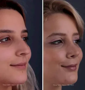 Ринопалстика в Стамбуле Yavuz Selim Yildirim