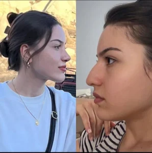 Ринопластика в Стамбуле Akin Zengin