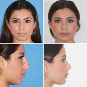 Ринопалстика в Стамбуле Ilker Manavbasi