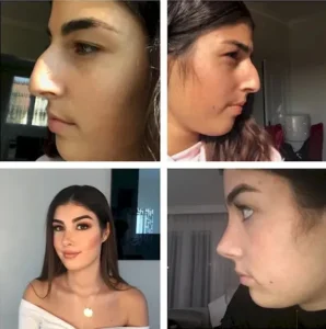 Пластика носа в Стамбуле Ilker Manavbasi