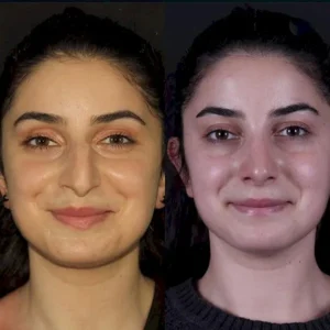 Ринопалстика в Стамбуле Engin Ocal