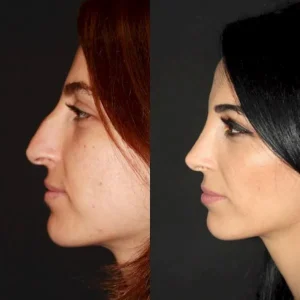 Пластика носа в Стамбуле Engin Ocal