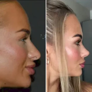 Ринопластика в Стамбуле Celal Alioglu