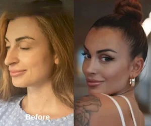 Пластика носа в Стамбуле Celal Alioglu