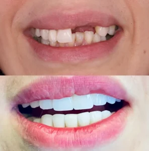 Цифровой дизайн улыбки в Турции Bulent Akdereli