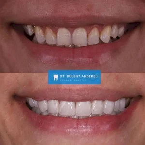 DSD в Турции Bulent Akdereli