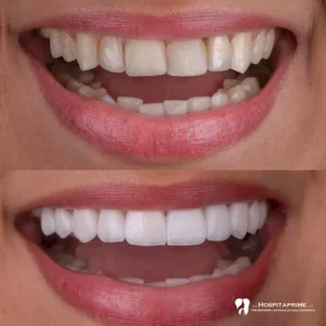 DSD в Турции Eren Pera