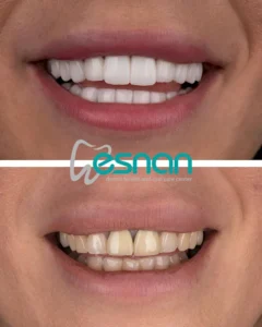 Цифровой дизайн улыбки в Турции Caner Cakli