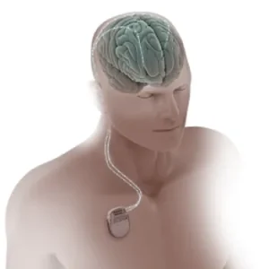 глубокая стимуляция мозга в турции при болезни паркинсона